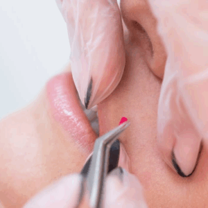 ELECTROLYSIS CONSULTATION IN CLINIC 45 minutes